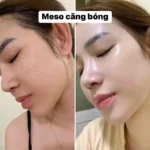 Tác Hại Của Tiêm Meso: Rủi Ro Và Lưu Ý Khi Sử Dụng